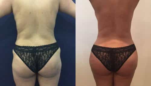 Before and After brazilian butt lift Colombia - Premium Care Plastic Surgery