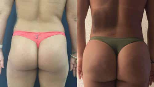 Before and After brazilian butt lift Colombia - Premium Care Plastic Surgery