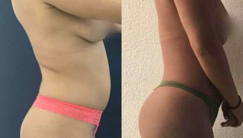 Before and After brazilian butt lift Colombia - Premium Care Plastic Surgery