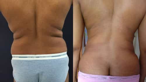 Before and After brazilian butt lift Colombia - Premium Care Plastic Surgery
