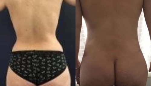 Before and After brazilian butt lift Colombia - Premium Care Plastic Surgery