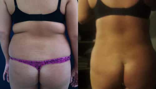 Before and After brazilian butt lift Colombia - Premium Care Plastic Surgery