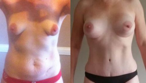 Breast Augmentation Colombia - Premium Care Plastic Surgery