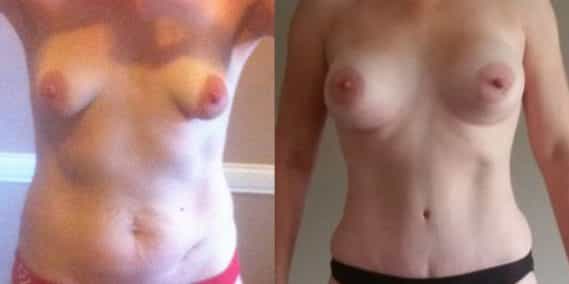 Breast Augmentation Colombia - Premium Care Plastic Surgery