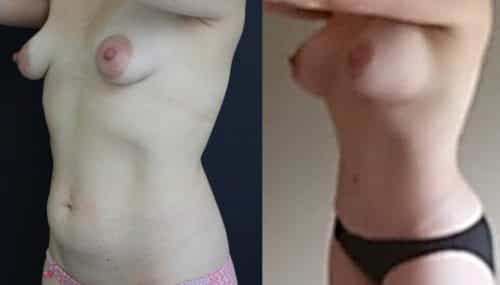 Breast Augmentation Colombia - Premium Care Plastic Surgery