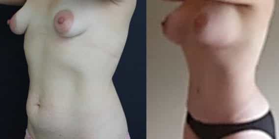 Breast Augmentation Colombia - Premium Care Plastic Surgery