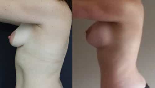 Breast Augmentation Colombia - Premium Care Plastic Surgery