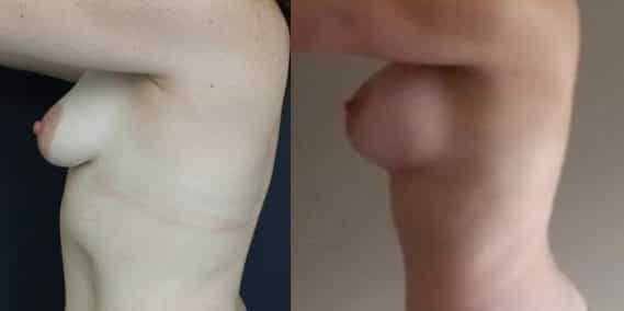 Breast Augmentation Colombia - Premium Care Plastic Surgery