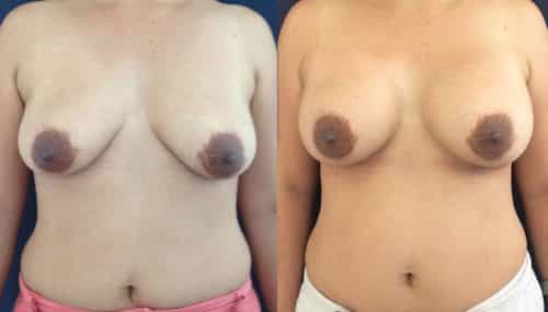 Breast Augmentation Colombia - Premium Care Plastic Surgery