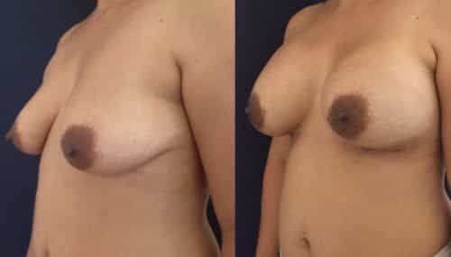 Breast Augmentation Colombia - Premium Care Plastic Surgery