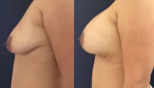 Breast Augmentation Colombia - Premium Care Plastic Surgery
