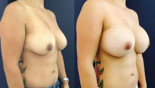 Breast Augmentation Colombia - Premium Care Plastic Surgery