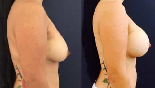 Breast Augmentation Colombia - Premium Care Plastic Surgery