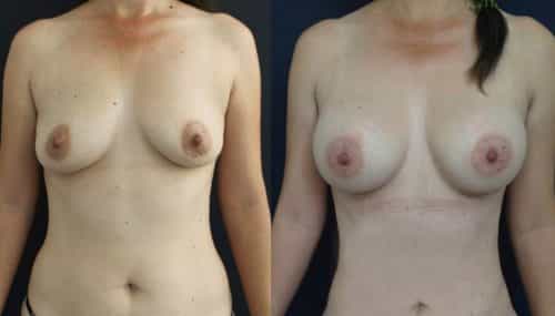 Breast Augmentation Colombia - Premium Care Plastic Surgery
