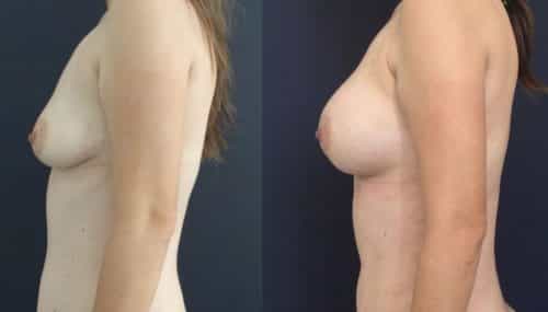 Breast Augmentation Colombia - Premium Care Plastic Surgery