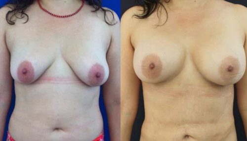 Breast Augmentation Colombia - Premium Care Plastic Surgery