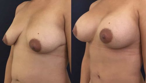 Breast Augmentation Colombia - Premium Care Plastic Surgery