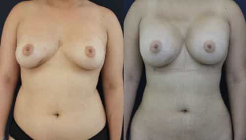 Breast Augmentation Colombia - Premium Care Plastic Surgery