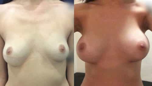 Breast Augmentation Colombia - Premium Care Plastic Surgery