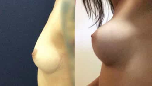 Breast Augmentation Colombia - Premium Care Plastic Surgery