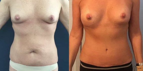 Breast Augmentation Colombia - Premium Care Plastic Surgery