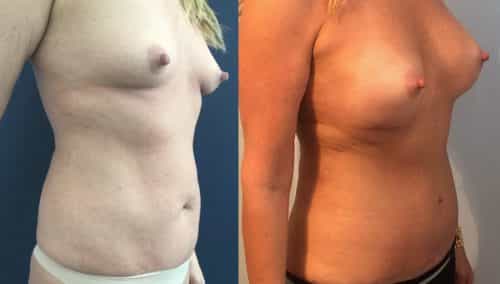 Breast Augmentation Colombia - Premium Care Plastic Surgery