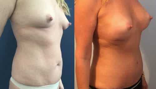 Breast Augmentation Colombia - Premium Care Plastic Surgery