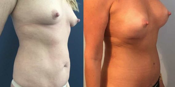 Breast Augmentation Colombia - Premium Care Plastic Surgery