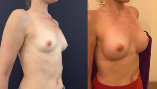 Breast Augmentation Colombia - Premium Care Plastic Surgery
