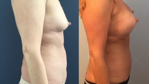 Breast Augmentation Colombia - Premium Care Plastic Surgery