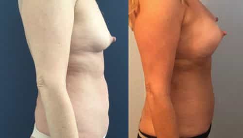 Breast Augmentation Colombia - Premium Care Plastic Surgery