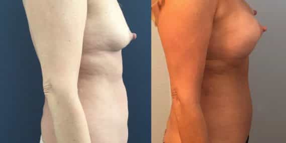 Breast Augmentation Colombia - Premium Care Plastic Surgery