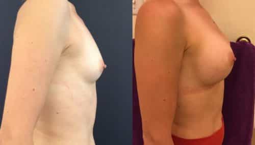 Breast Augmentation Colombia - Premium Care Plastic Surgery