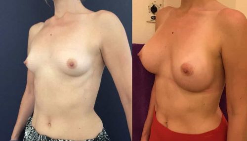 Breast Augmentation Colombia - Premium Care Plastic Surgery