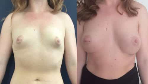 Breast Augmentation Colombia - Premium Care Plastic Surgery