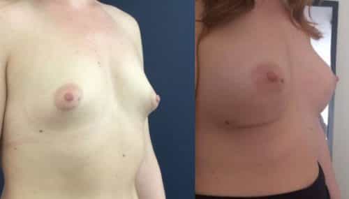 Breast Augmentation Colombia - Premium Care Plastic Surgery