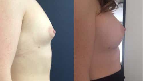 Breast Augmentation Colombia - Premium Care Plastic Surgery