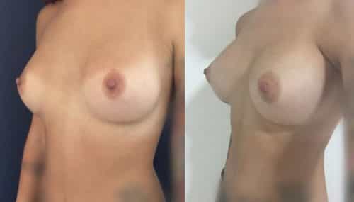 Breast Augmentation Colombia - Premium Care Plastic Surgery