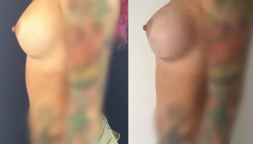 Breast Augmentation Colombia - Premium Care Plastic Surgery