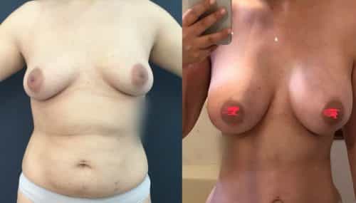 Breast Augmentation Colombia - Premium Care Plastic Surgery