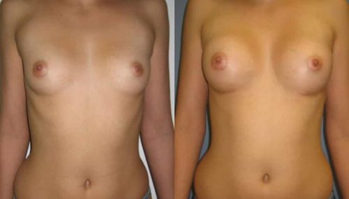 Breast Augmentation Colombia - Premium Care Plastic Surgery