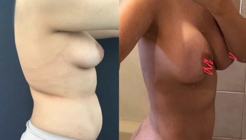 Breast Augmentation Colombia - Premium Care Plastic Surgery
