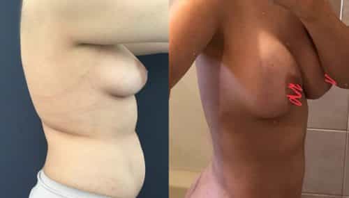 Breast Augmentation Colombia - Premium Care Plastic Surgery