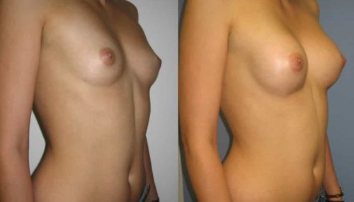 Breast Augmentation Colombia - Premium Care Plastic Surgery