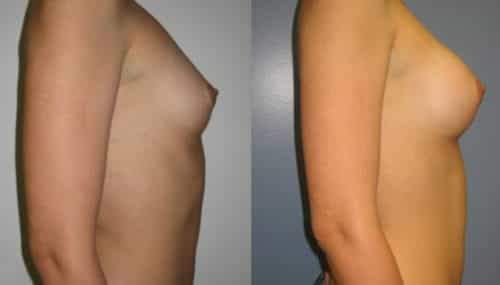 Breast Augmentation Colombia - Premium Care Plastic Surgery