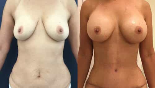 Breast Augmentation Colombia - Premium Care Plastic Surgery