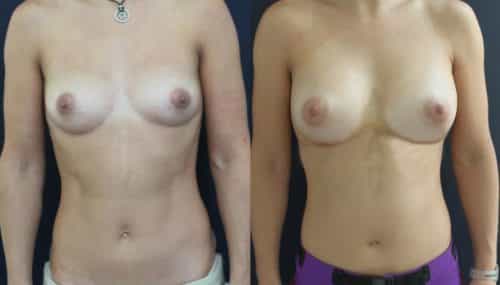 Breast Augmentation Colombia - Premium Care Plastic Surgery