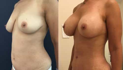 Breast Augmentation Colombia - Premium Care Plastic Surgery