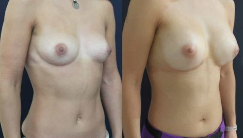 Breast Augmentation Colombia - Premium Care Plastic Surgery