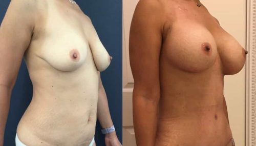 Breast Augmentation Colombia - Premium Care Plastic Surgery